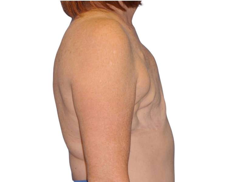 Breast Reconstruction Before & After Patient #810