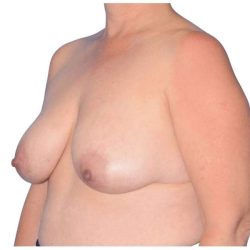 Breast Reconstruction Before & After Patient #828