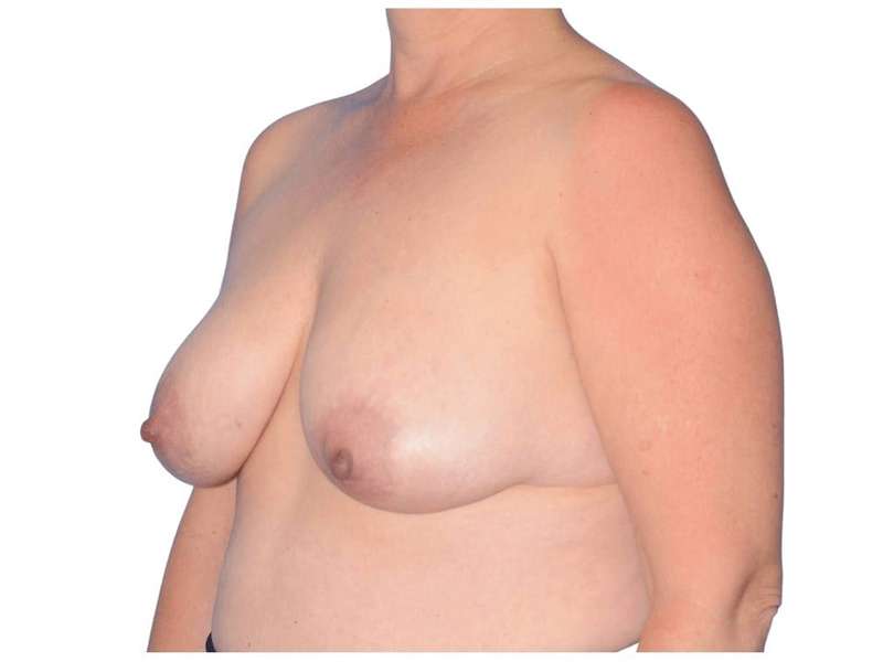 Breast Reconstruction Before & After Patient #828