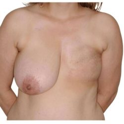 Breast Reconstruction Before & After Patient #837