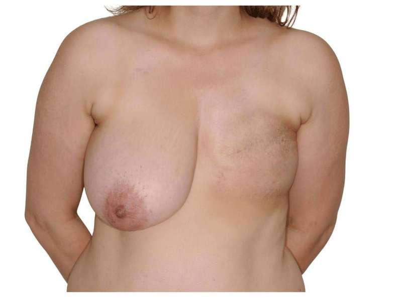 Breast Reconstruction Before & After Patient #837
