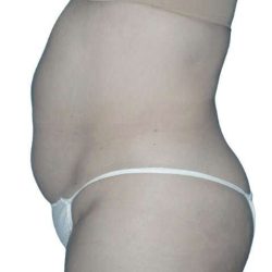 Tummy Tuck Before & After Patient #464