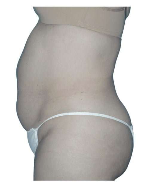 Tummy Tuck Before & After Patient #464
