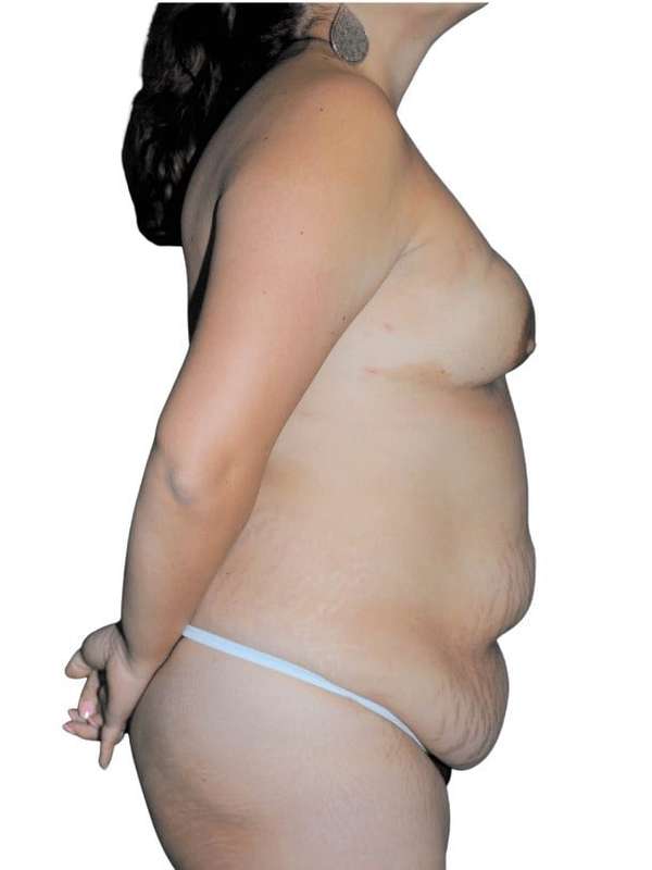Breast Reconstruction Before & After Patient #873