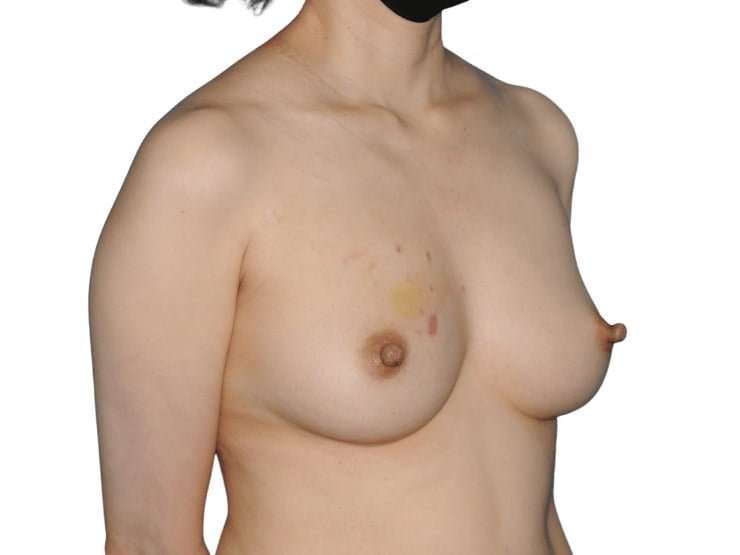Breast Reconstruction Before & After Patient #880