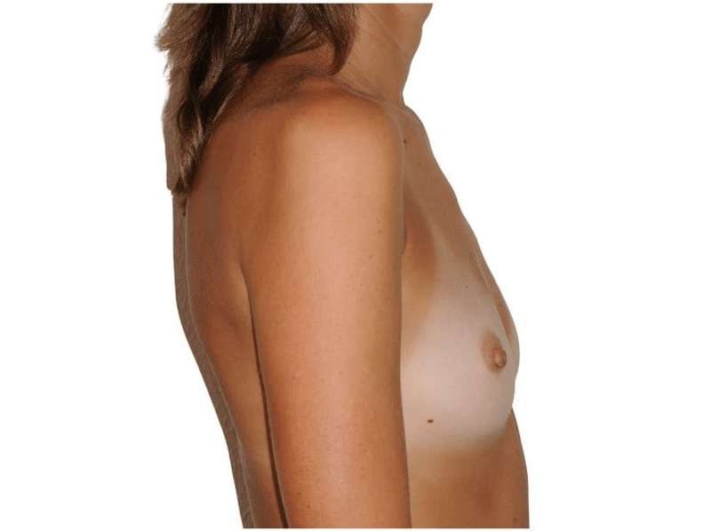 Breast Reconstruction Before & After Patient #912
