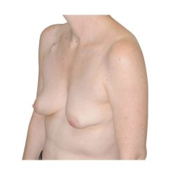 Breast Reconstruction Before & After Patient #930