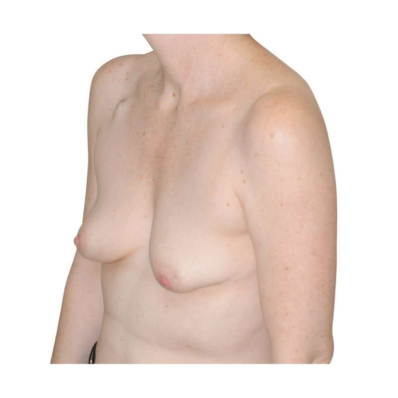 Breast Reconstruction Before & After Patient #930