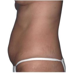Tummy Tuck Before & After Patient #469