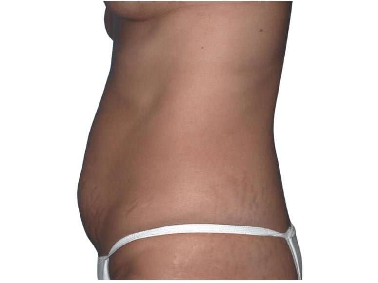 Tummy Tuck Before & After Patient #469