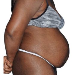 Tummy Tuck Before & After Patient #478