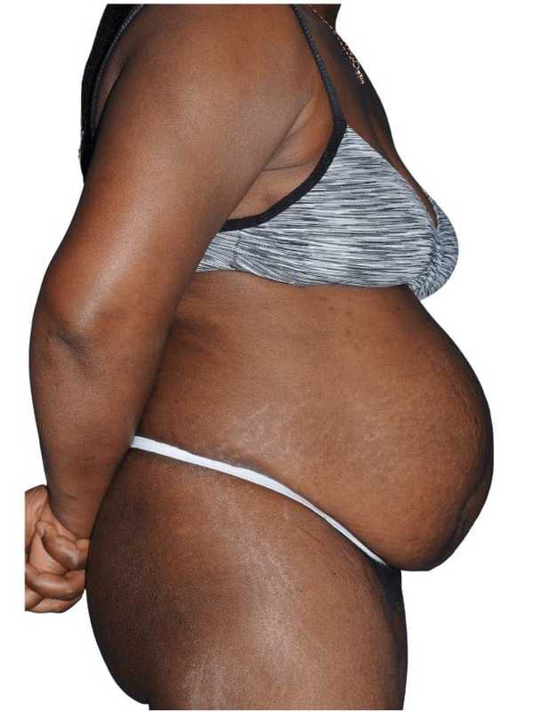 Tummy Tuck Before & After Patient #478