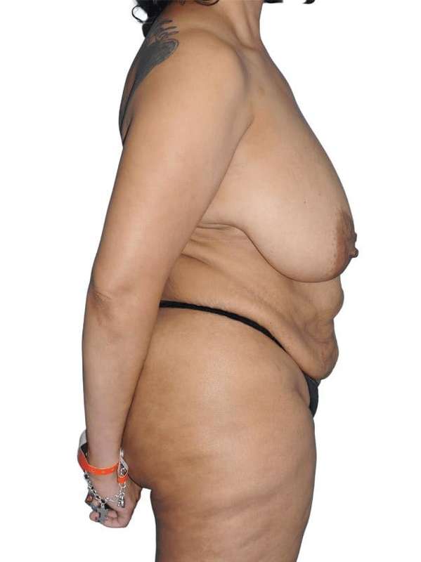 Mommy Makeover Before & After Patient #433