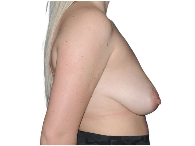 Breast Lift Before & After Patient #572