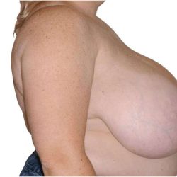 Breast Reduction Before & After Patient #579