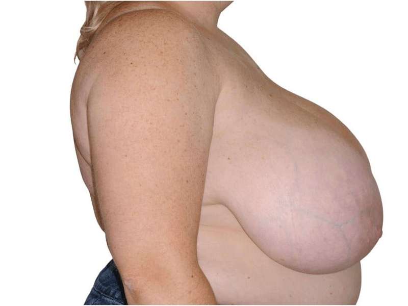 Breast Reduction Before & After Patient #579