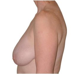 Breast Reduction Before & After Patient #586