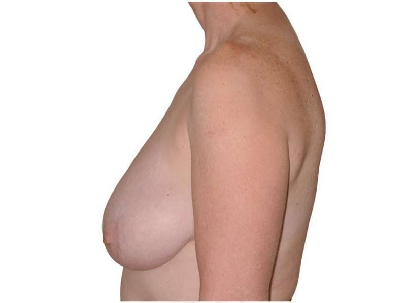 Breast Reduction Before & After Patient #586