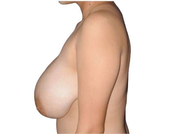 Breast Reduction Before & After Patient #593