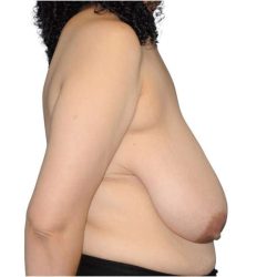 Breast Reduction Before & After Patient #601
