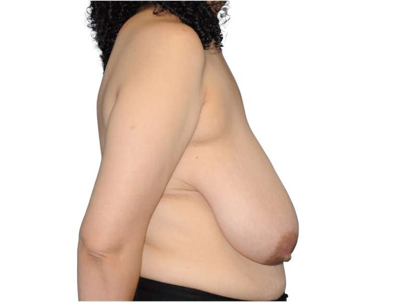 Breast Reduction Before & After Patient #601