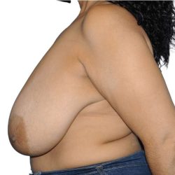 Breast Reduction Before & After Patient #610