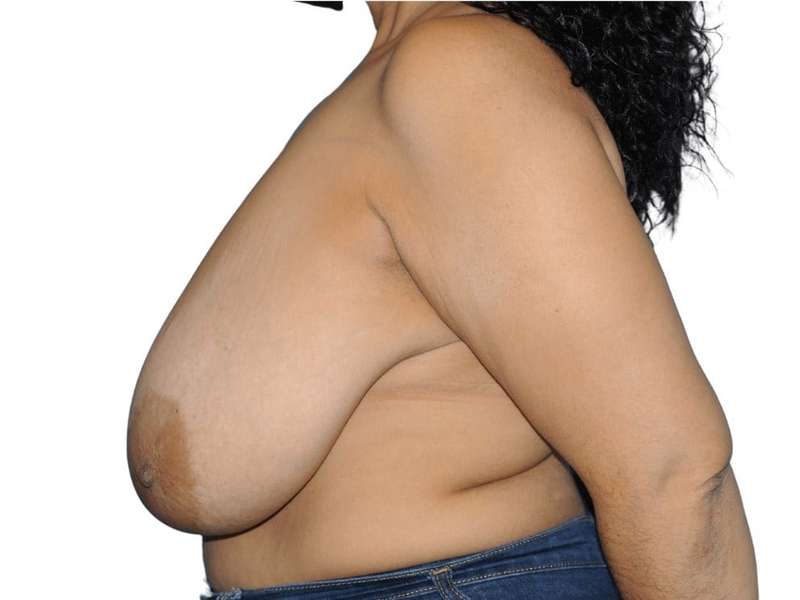 Breast Reduction Before & After Patient #610