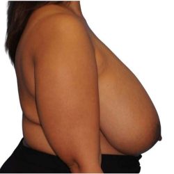 Breast Reduction Before & After Patient #617