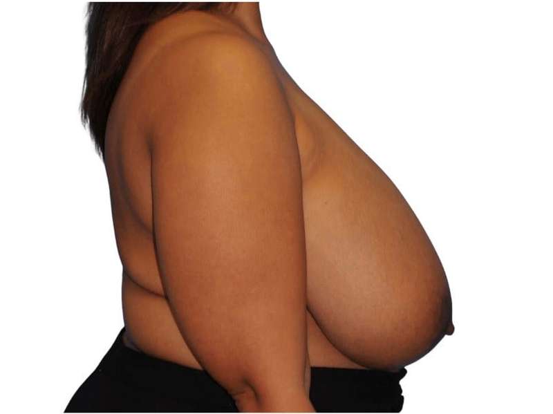 Breast Reduction Before & After Patient #617