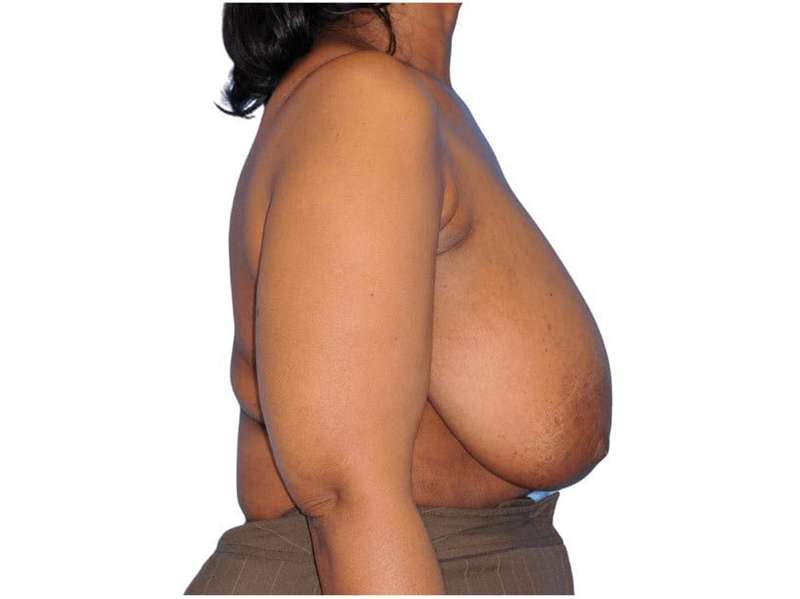 Breast Reduction Before & After Patient #642