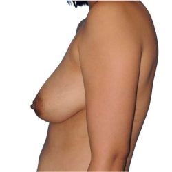 Breast Augmentation Before & After Patient #656