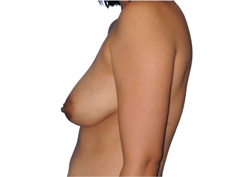 Breast Augmentation Before & After Patient #656