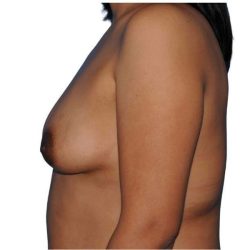 Breast Augmentation Before & After Patient #663