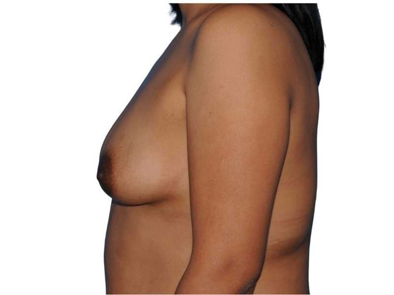 Breast Augmentation Before & After Patient #663