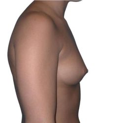 Breast Augmentation Before & After Patient #670