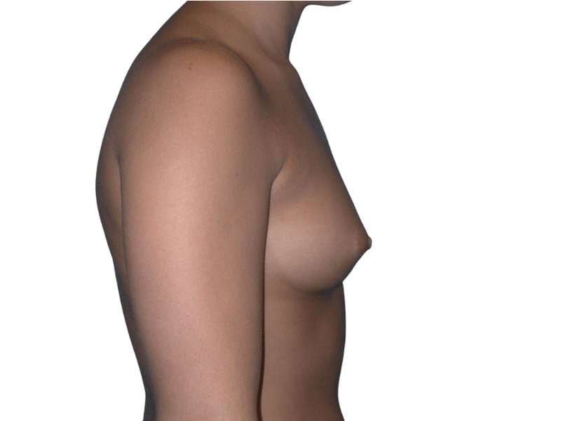 Breast Augmentation Before & After Patient #670