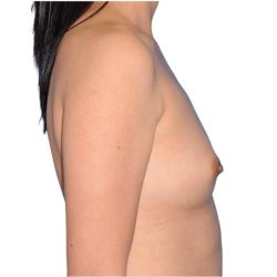 Breast Augmentation Before & After Patient #679