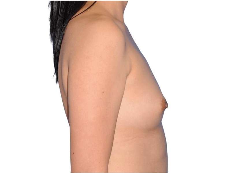 Breast Augmentation Before & After Patient #679