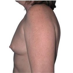 Breast Augmentation Before & After Patient #686