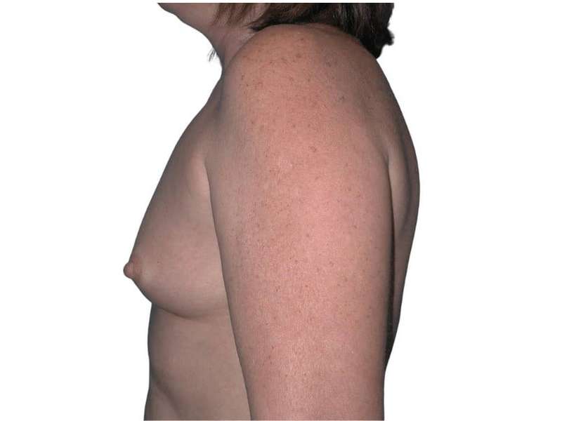 Breast Augmentation Before & After Patient #686