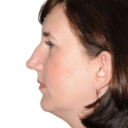 Rhinoplasty Before & After Patient #418