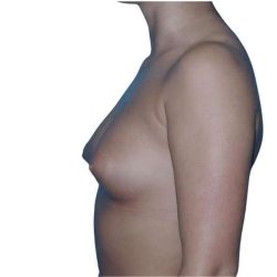 Breast Augmentation Before & After Patient #700