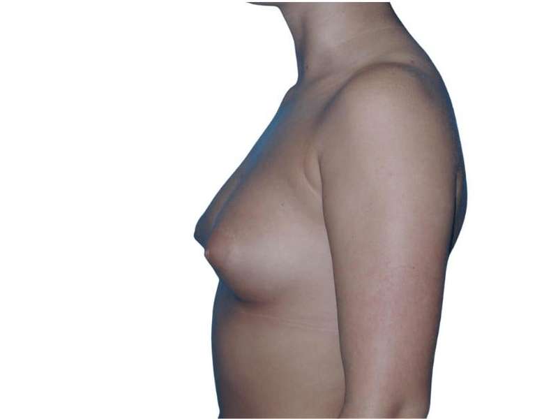 Breast Augmentation Before & After Patient #700