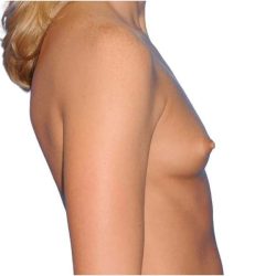 Breast Augmentation Before & After Patient #707