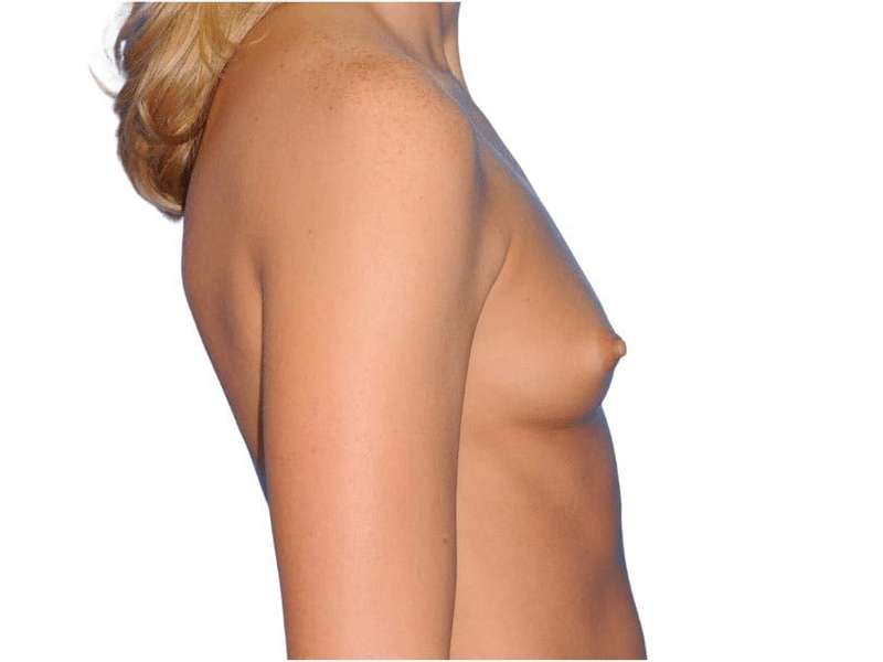 Breast Augmentation Before & After Patient #707
