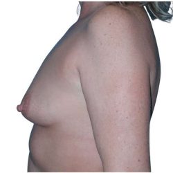 Breast Augmentation Before & After Patient #714