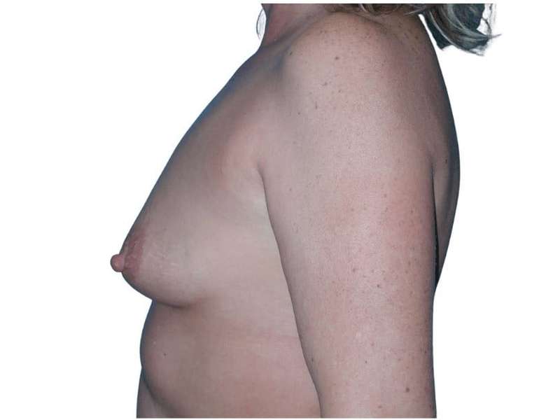 Breast Augmentation Before & After Patient #714