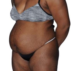 Tummy Tuck Before & After Patient #478