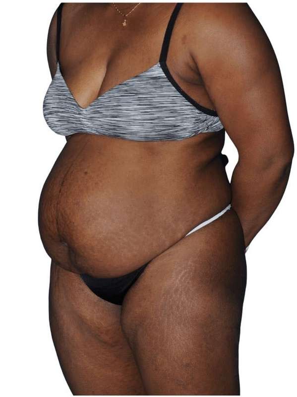 Tummy Tuck Before & After Patient #478