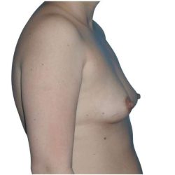 Breast Augmentation Before & After Patient #721